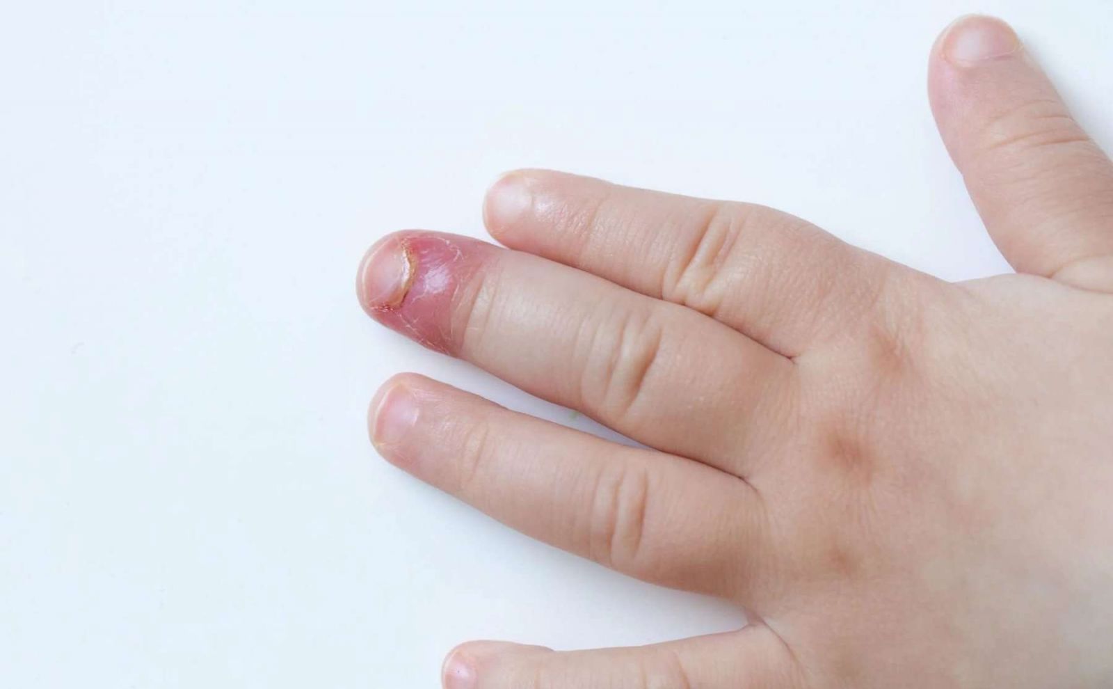 5 Bài thuốc dân gian chữa chín mé