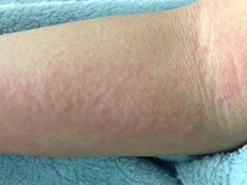 27 Bài thuốc điều trị mẩn ngứa ngoài da