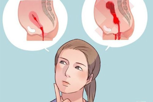 Cần phải làm gì khi bị Băng huyết sau sinh