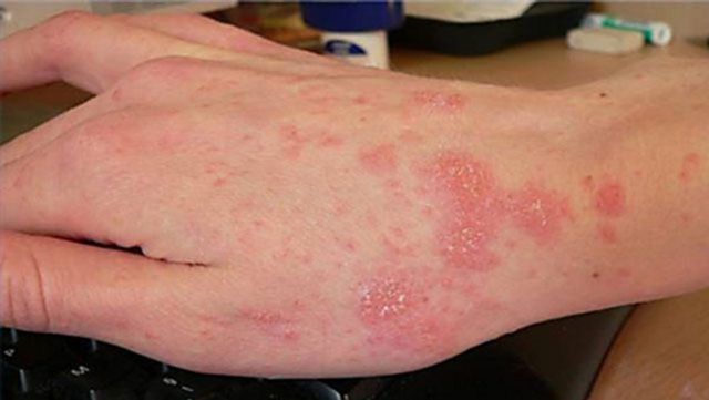 Chữa các chứng ghẻ, lở loét, hắc lào, sau quảng theo dân gian