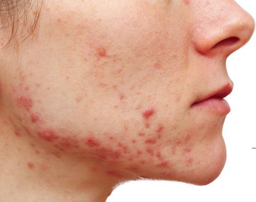 Bài thuốc kinh phòng bại độc tán điều trị da mưng mủ cấp tính