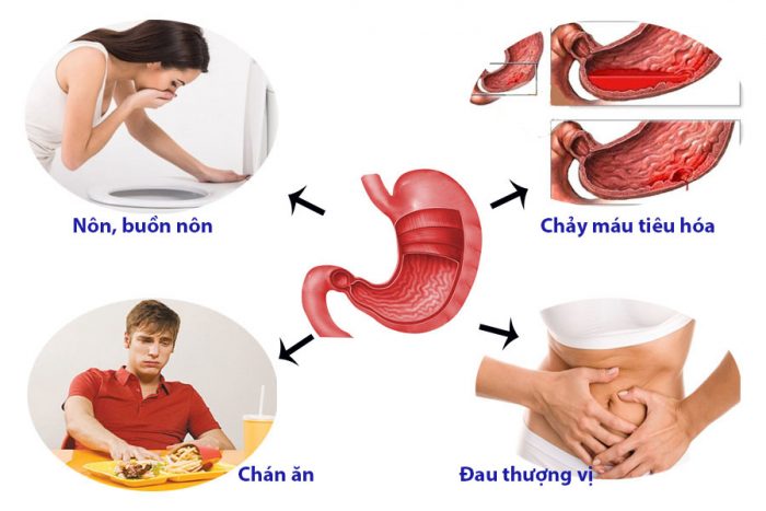 Cách dùng thuốc kết hợp trong điều trị đau dạ dày