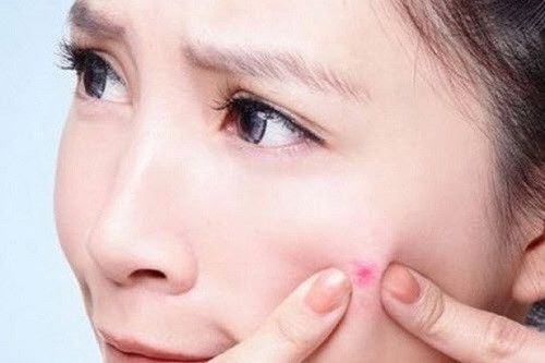 Đọc ngay để biết cách chăm sóc trẻ bị mụn nhọt