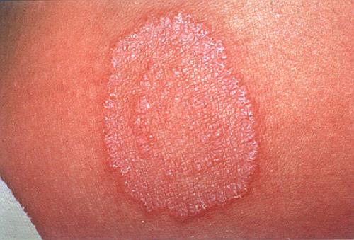 Một số bài thuốc dân gian điều trị các bệnh nấm ngoài da