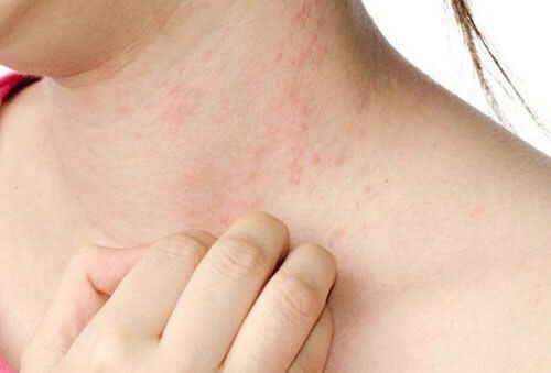 44 Mẹo chữa mẩn ngứa và các bệnh ngoài da