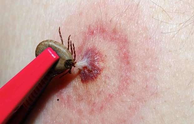 Cách phòng côn trùng cắn cho trẻ nhỏ