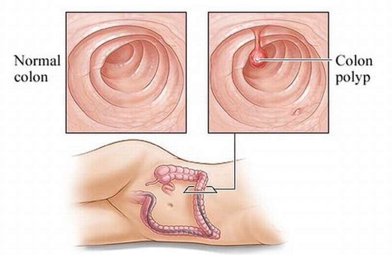 Polyp đại tràng là gì?