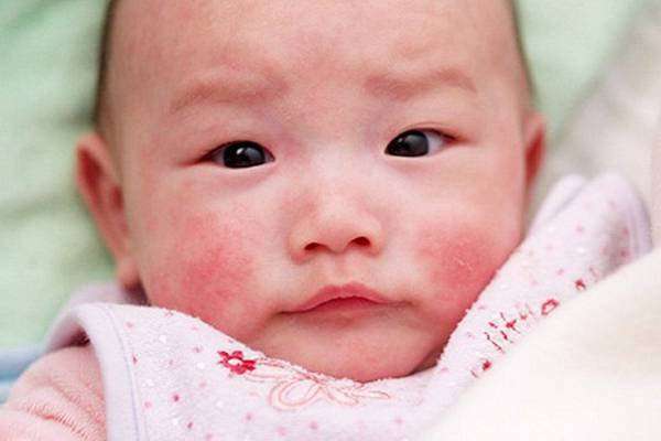 Các vấn đề về da ở trẻ sơ sinh và cách đối phó mẩn ngứa do tã