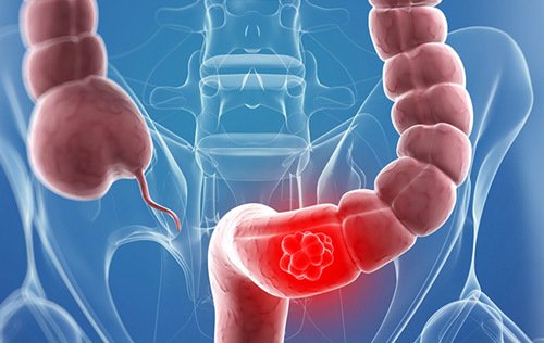 Bài thuốc gia vị ôn đảm thang điều trị viêm đại tràng