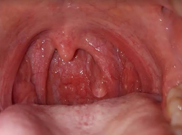 Những bài thuốc dân gian chữa viêm họng